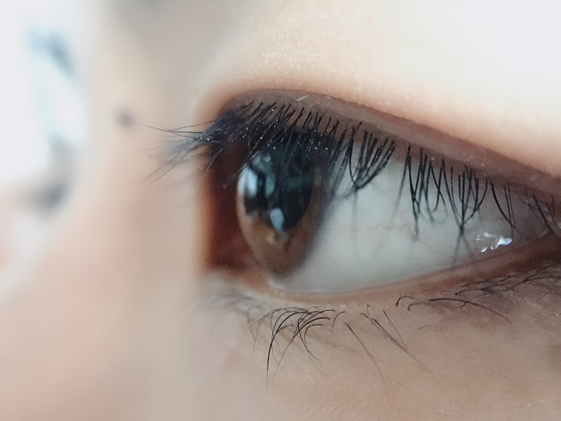 上眼皮為什么會下垂？上瞼下垂是怎么引起的？