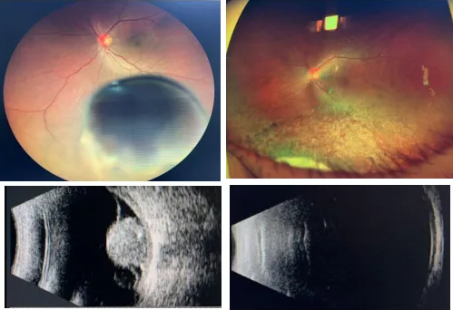 脈絡膜黑色素瘤